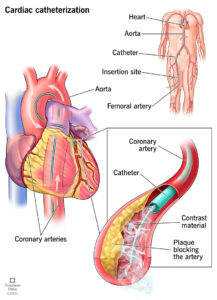 Cateterismo Cardíaco: Finalidade, Procedimento e Recuperação